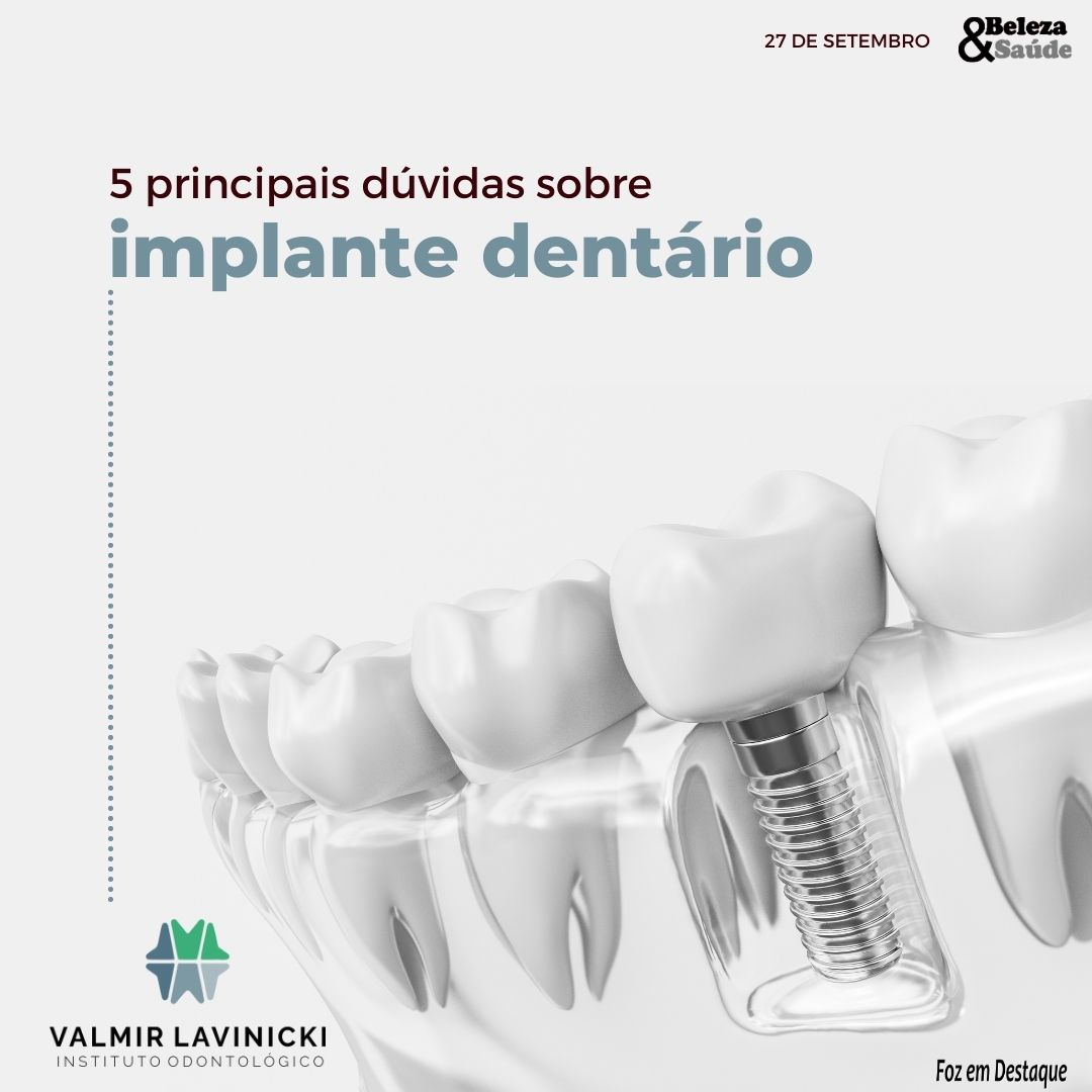 5 PRINCIPAIS DÚVIDAS SOBRE IMPLANTE DENTÁRIO bs-lavinicki-1-15