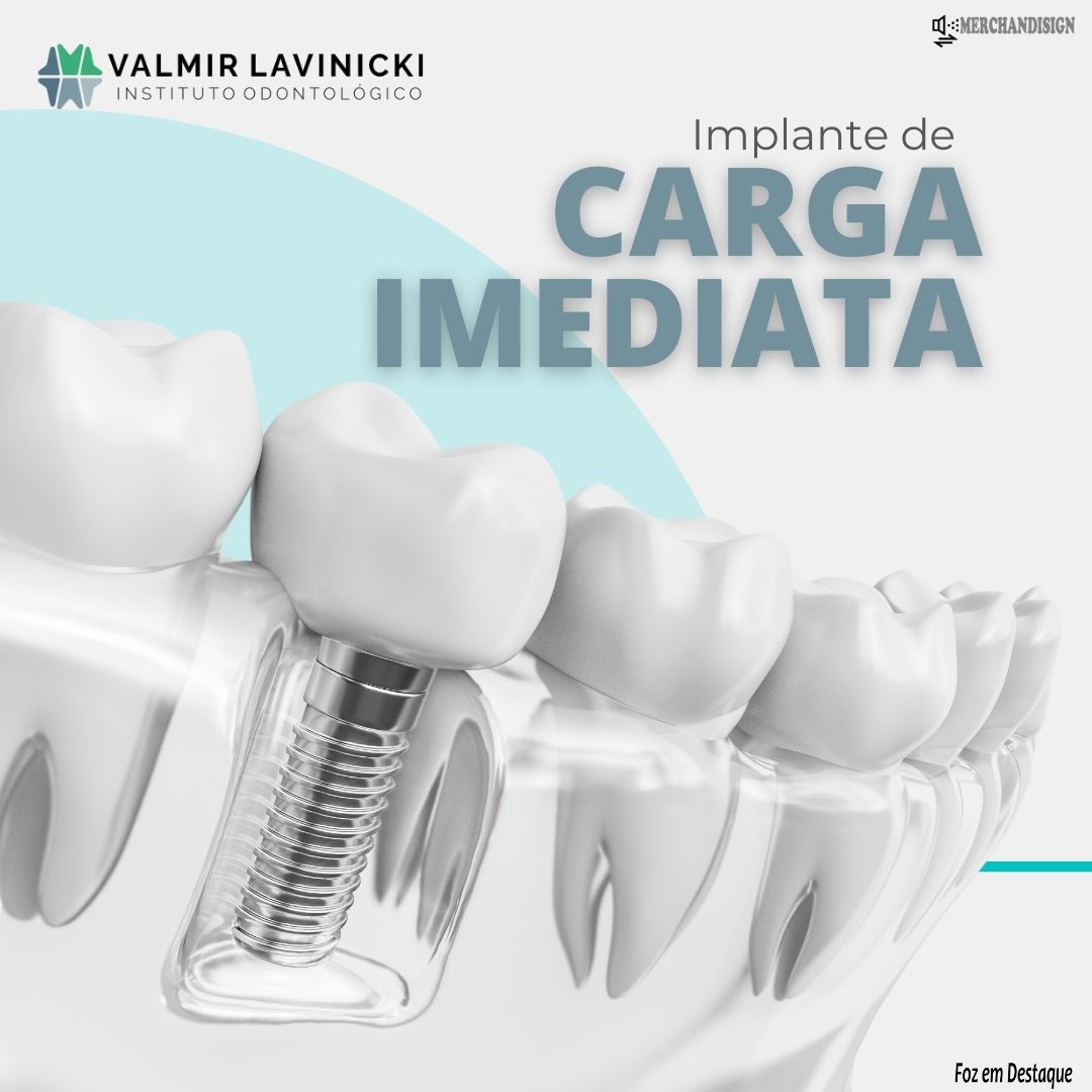 Implante de Carga Imediata bs-lavinicki-1-2