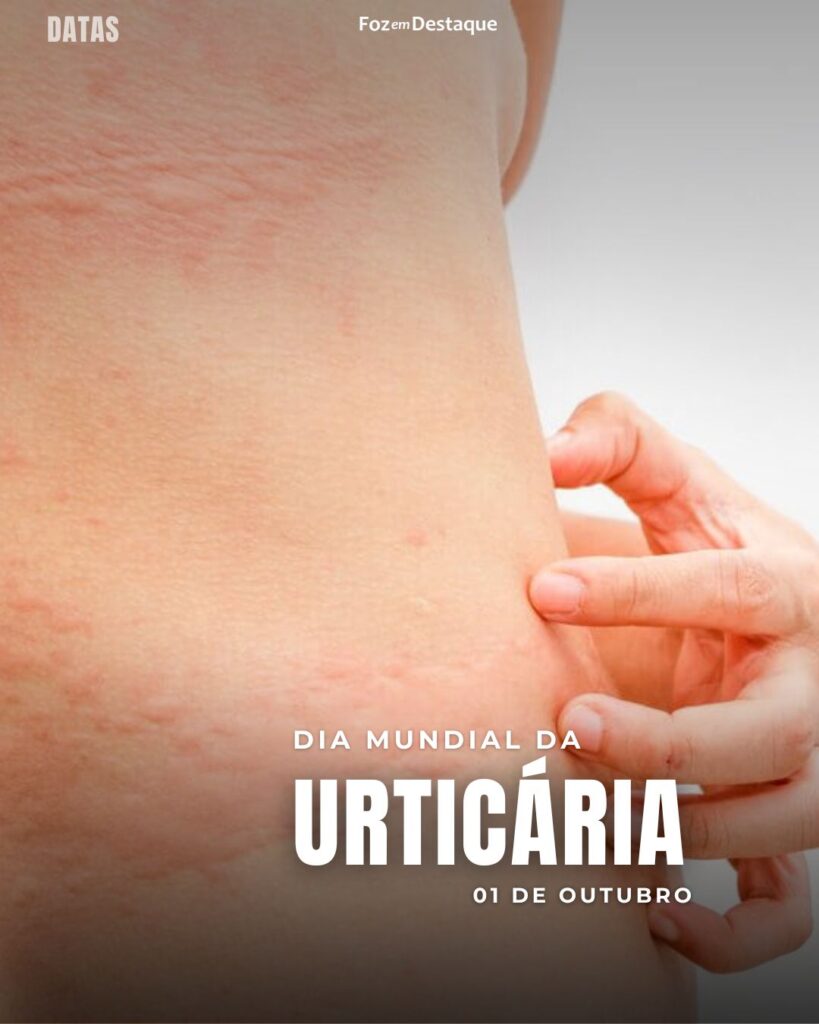 Dia Mundial da Urticária
Datas 01 de outubro 2024