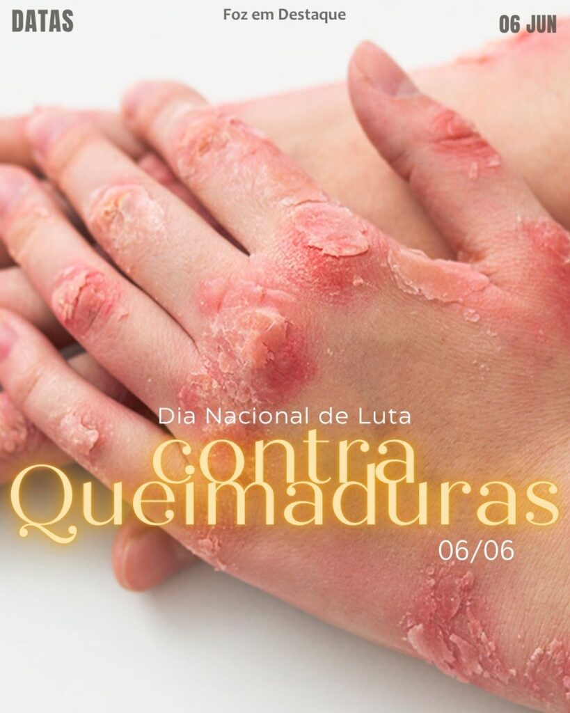 Dia Nacional de Luta contra Queimaduras
Datas 06 de junho 2025 Foz em Destaque "Sua Vida mais divertida".