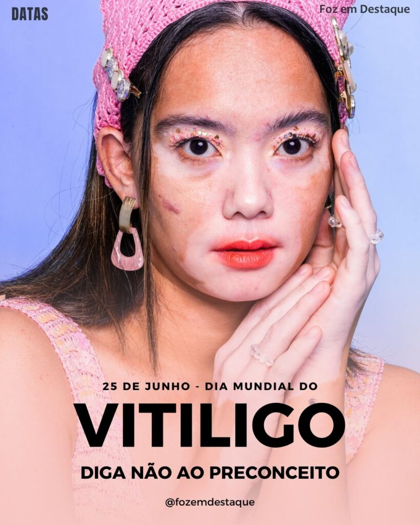 Dia Mundial do Vitiligo
Datas Comemorativas 25 de Junho