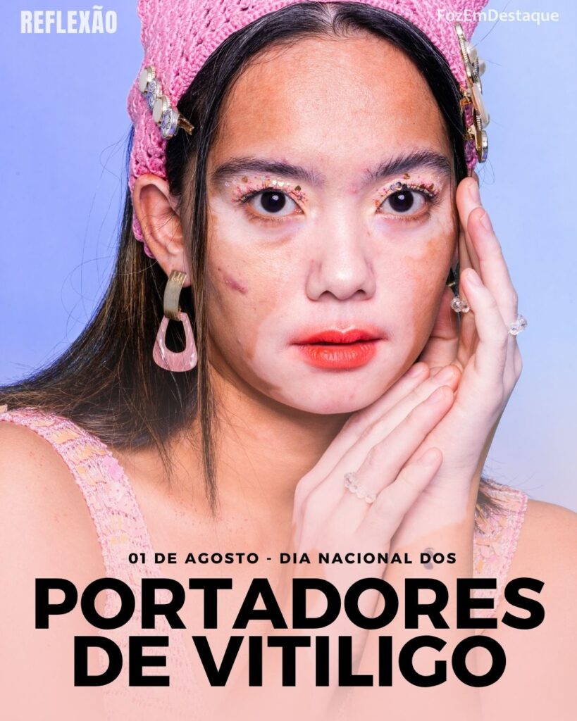 Dia Nacional dos Portadores de Vitiligo: visibilidade e empatia